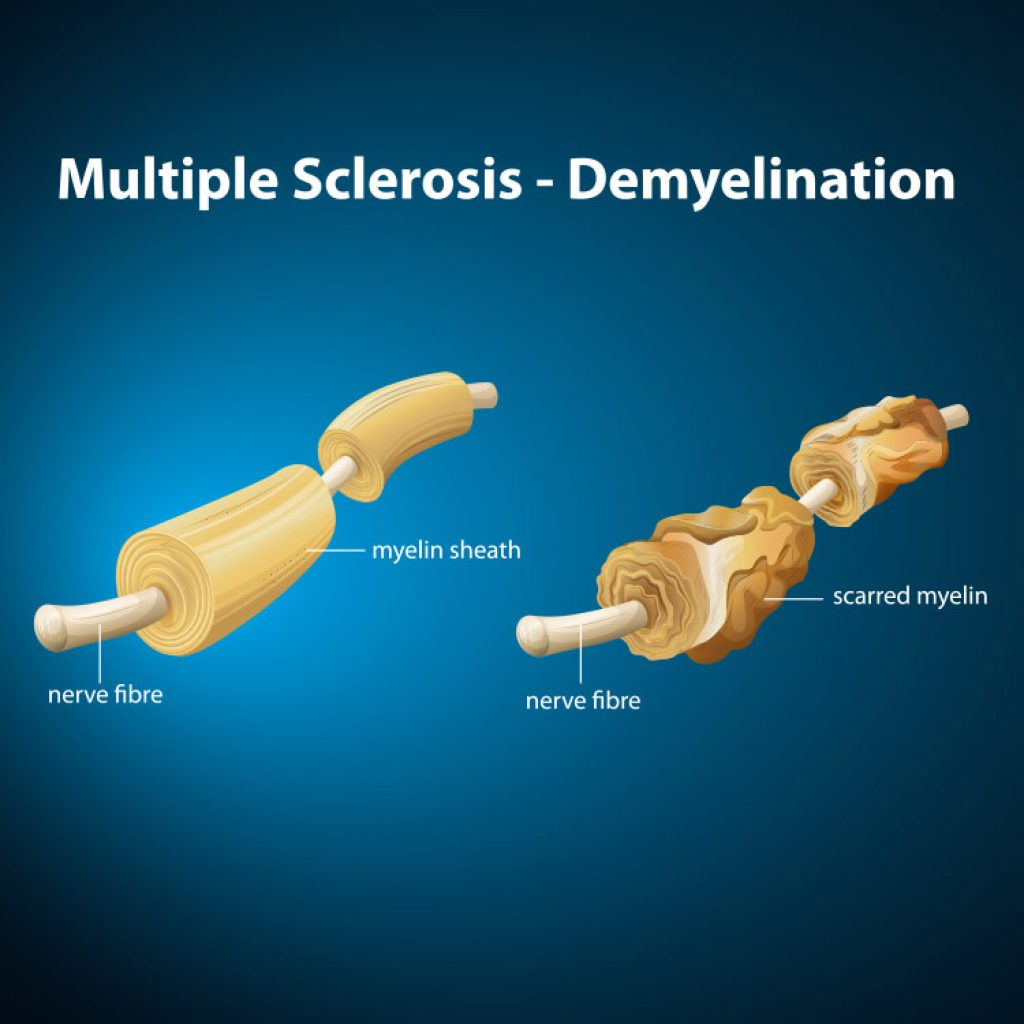 What is Multiple Sclerosis (MS) - MS Australia What is Multiple Sclerosis (MS) - MS Australia